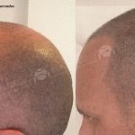 Micropigmentação Capilar em cabelo rapado em homem