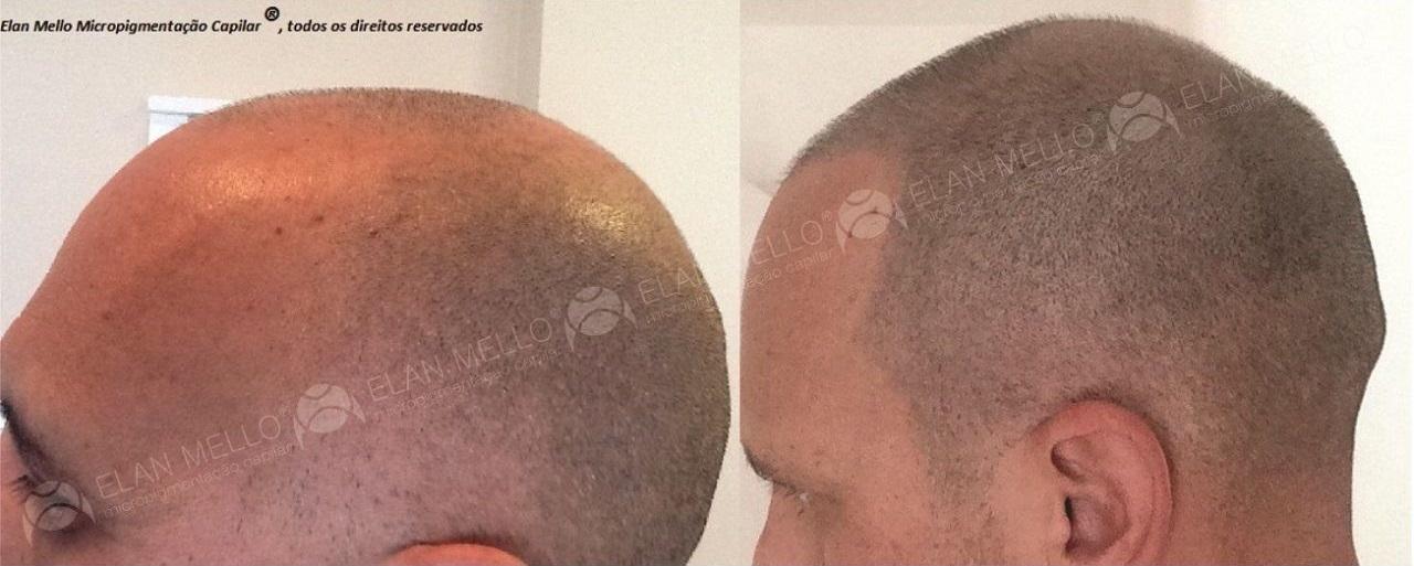 Micropigmentação Capilar em cabelo rapado em homem