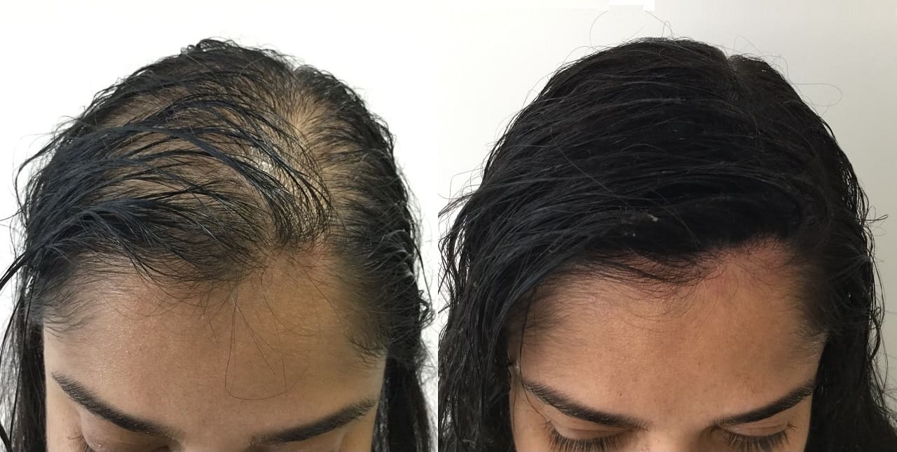 micropigmentação capilar em calvície de mulher