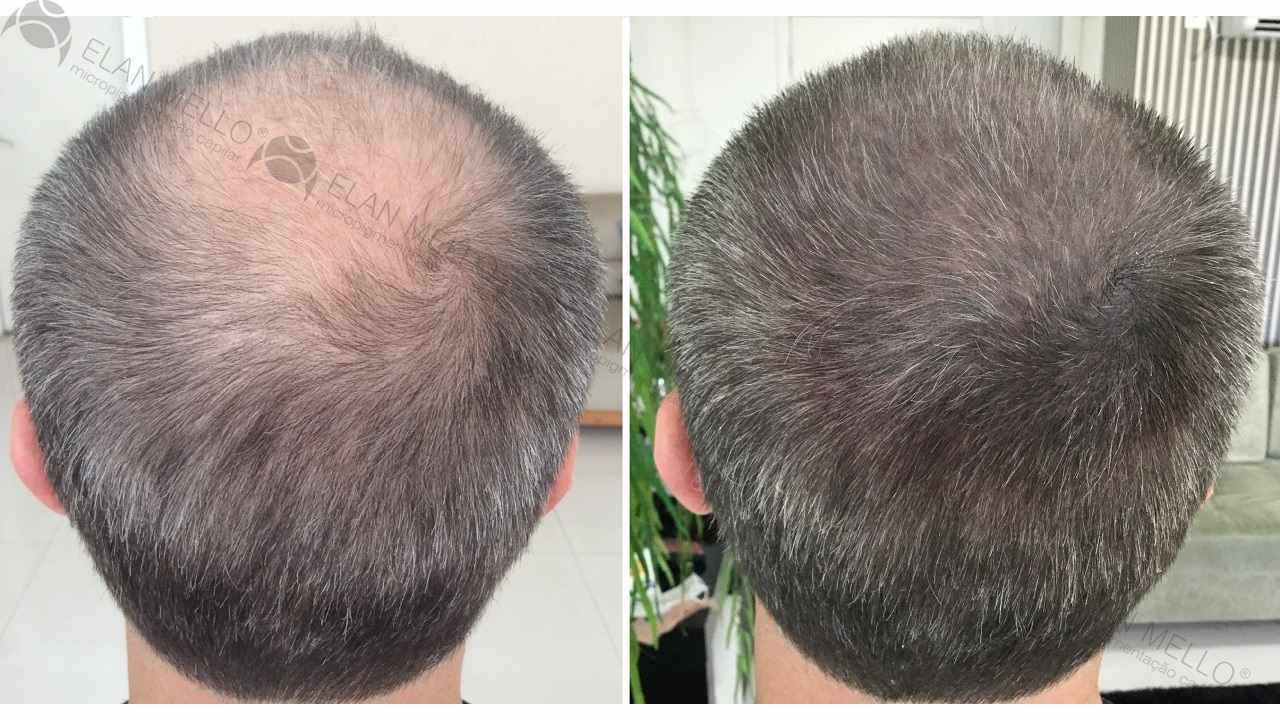 micropigmentação capilar em homem de cabelo grisalho na coroa de transplante