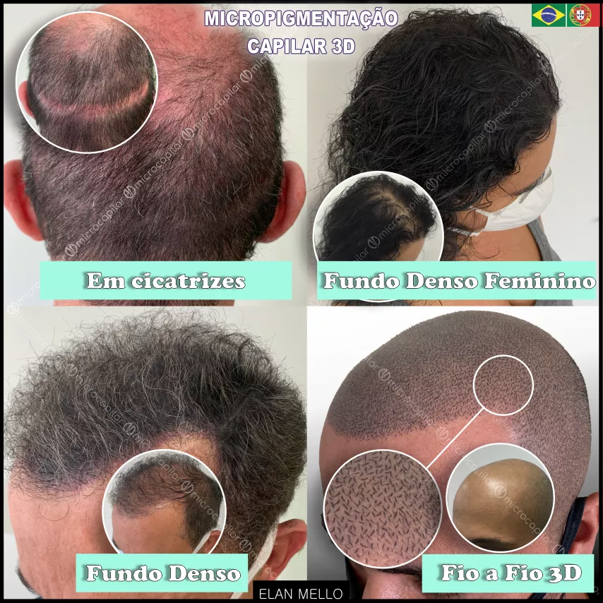 Micropigmentação Capilar em Cicatrizes no couro cabeludo em mulheres e homens com cabelo grande ou raspado