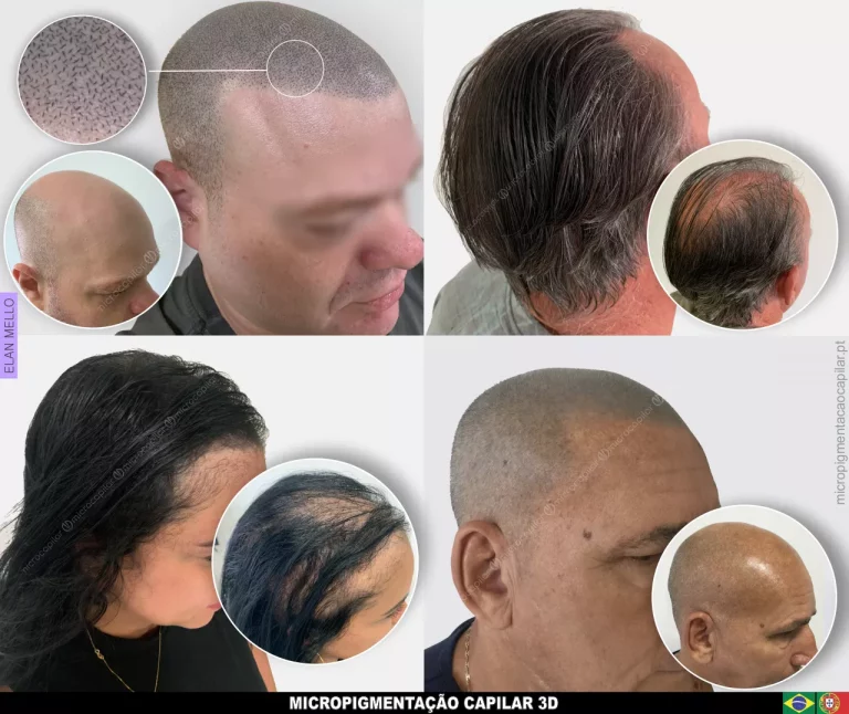 Micropigmentação Capilar fio a fio 3d  para cabelo raspado e densidade para cabelo grande em homens e mulheres